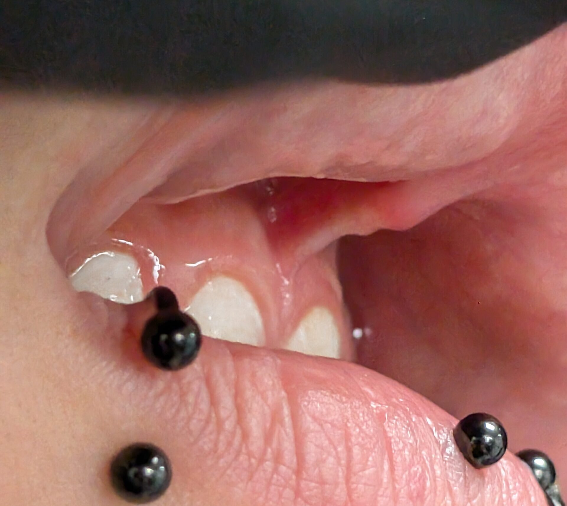 Close-up of a rejected smiley piercing showing migration near the gum line.