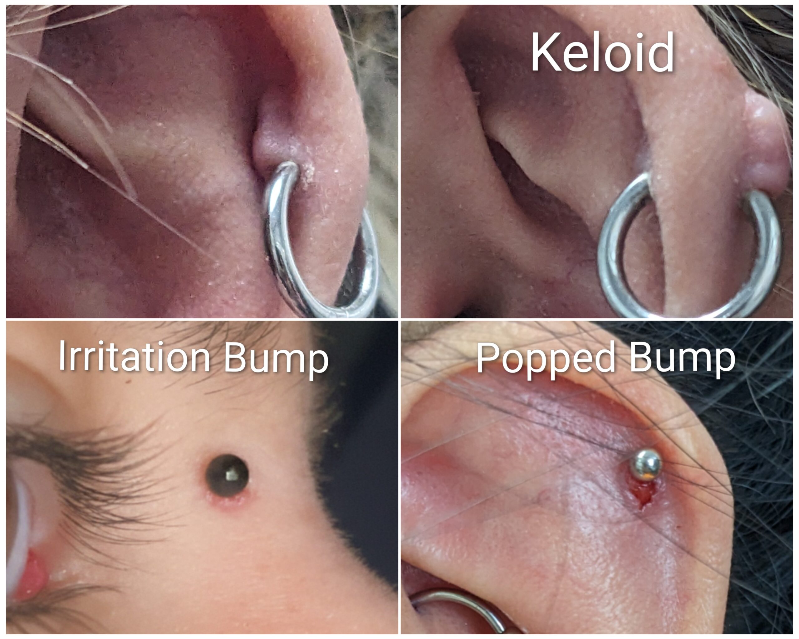 Difference-Between-Keloid-and-Irritation-Bump