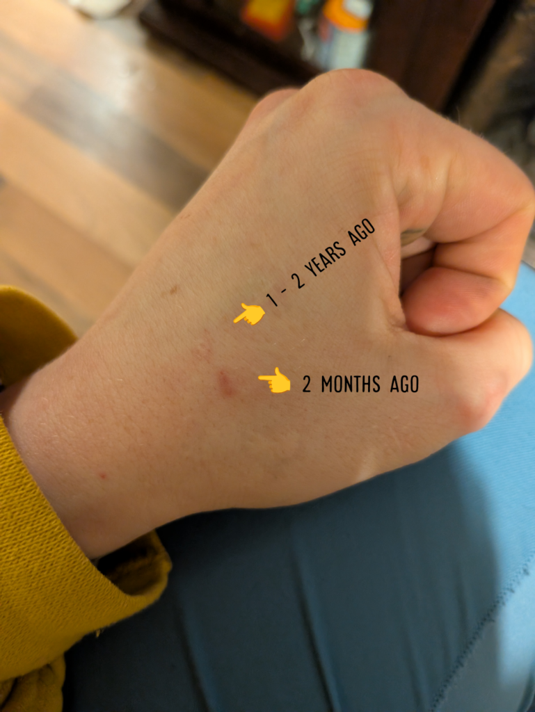 A hand showing two fully healed injectable microchip implants, one at 1 -2 years and one at 2 months.