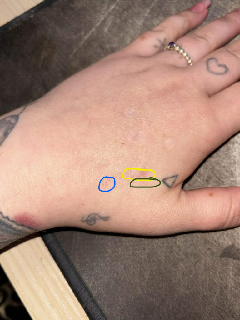 A hand showing two fully healed injectable microchip implants, one at 6 months.
